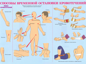 Способы временной остановки кровотечений
